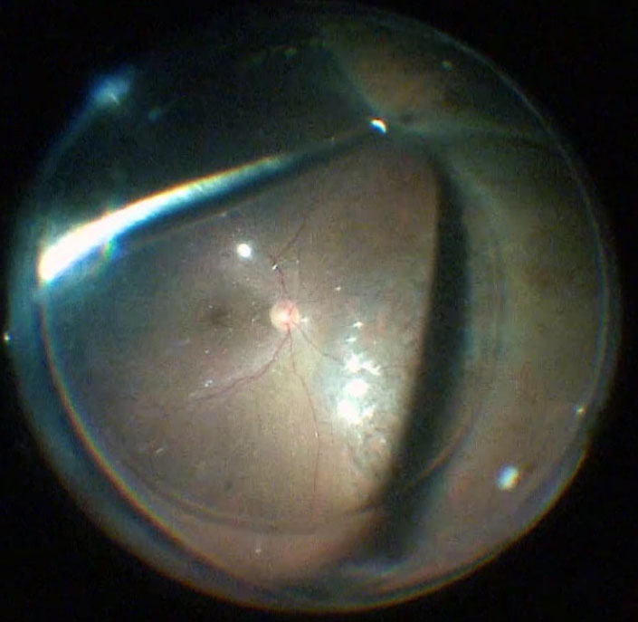 Figure 5.2.3 Scleral Depression with Shaving of Vitreous Near Tear
