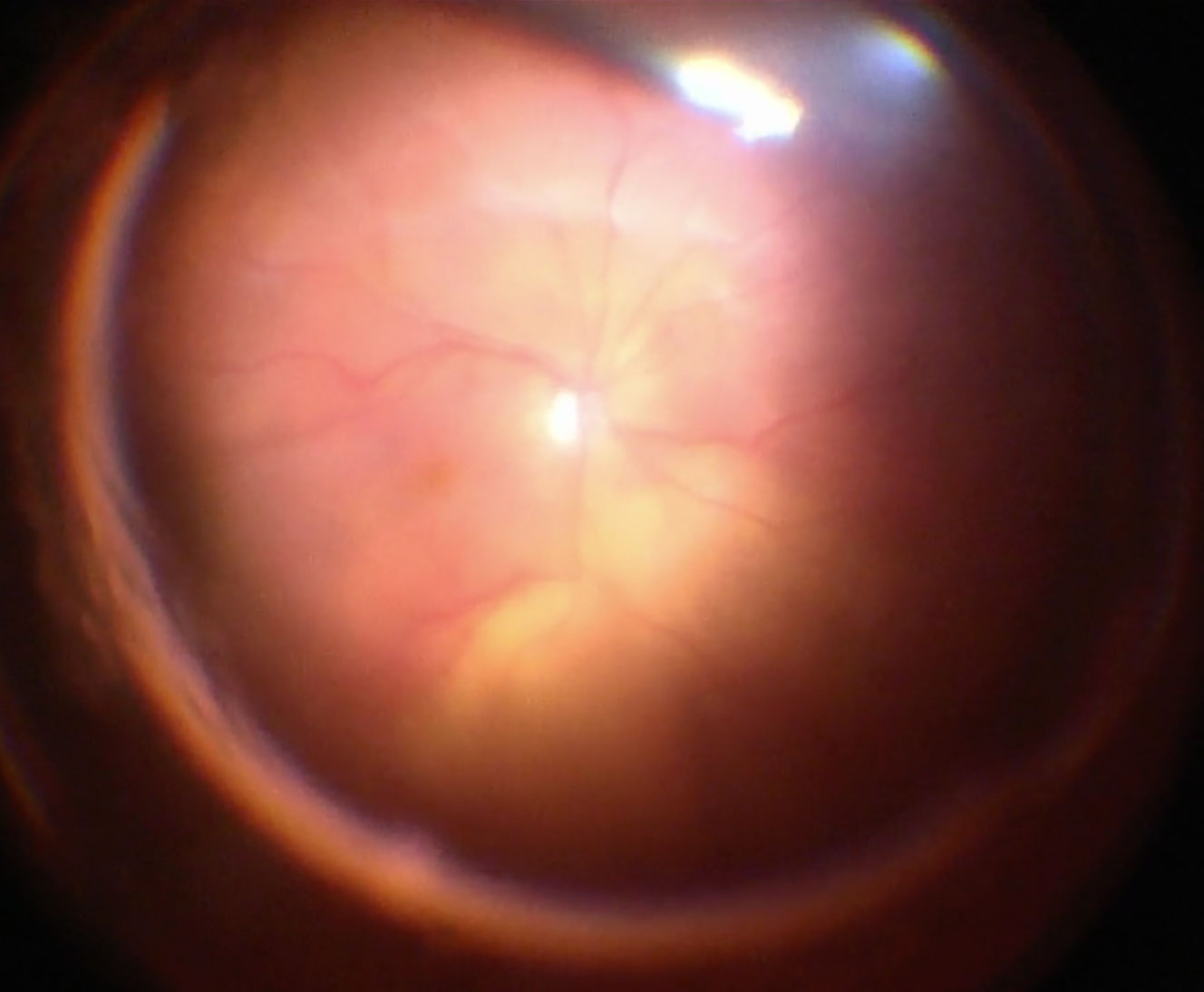 Figure 10.1.1 Total Retinal Detachment
