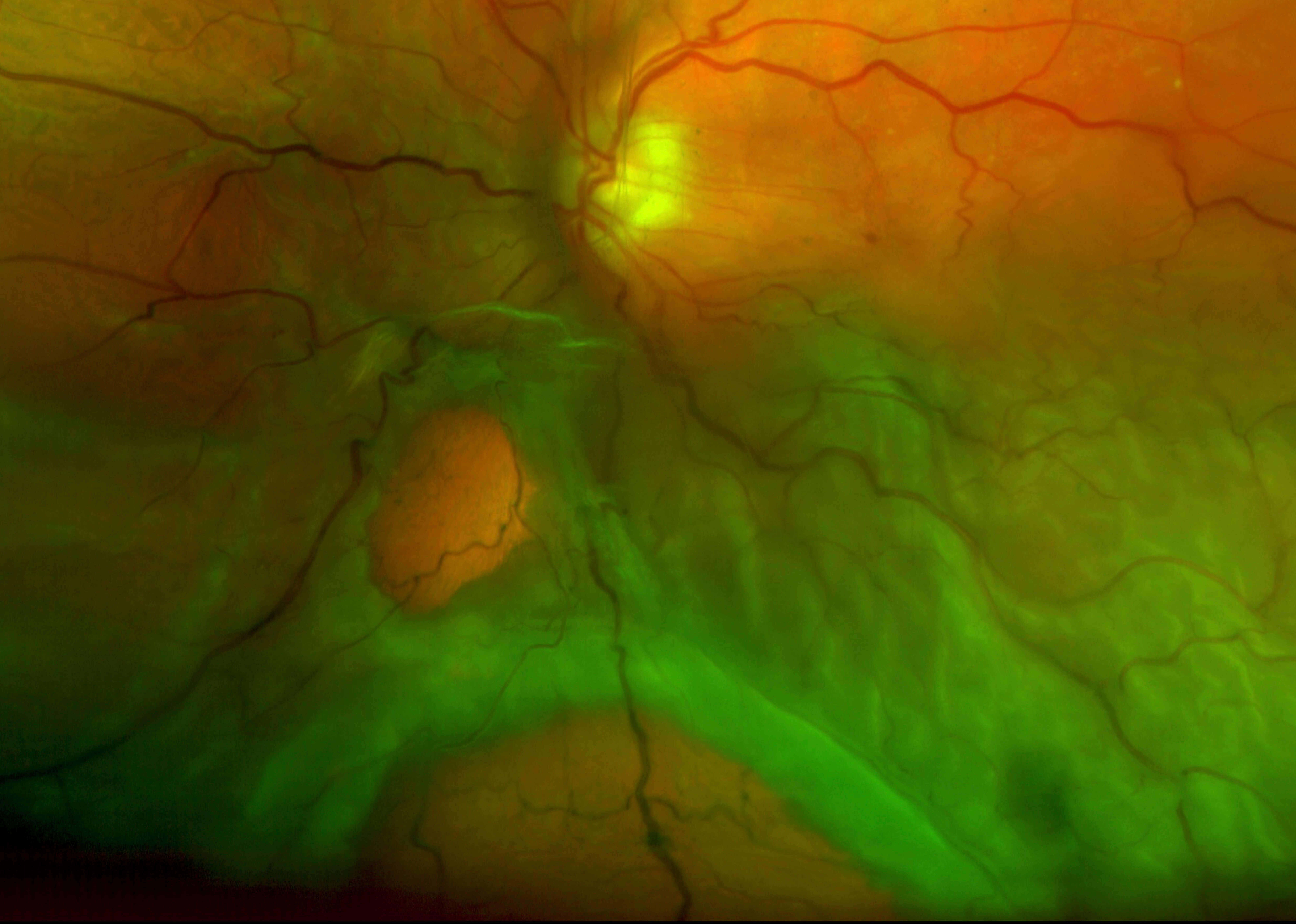Figure 13.3.1 Degenerative Retinoschisis with a Large Outer Hole Break Leading to a Concurrent Rhegmatogenous Retinal Detachment