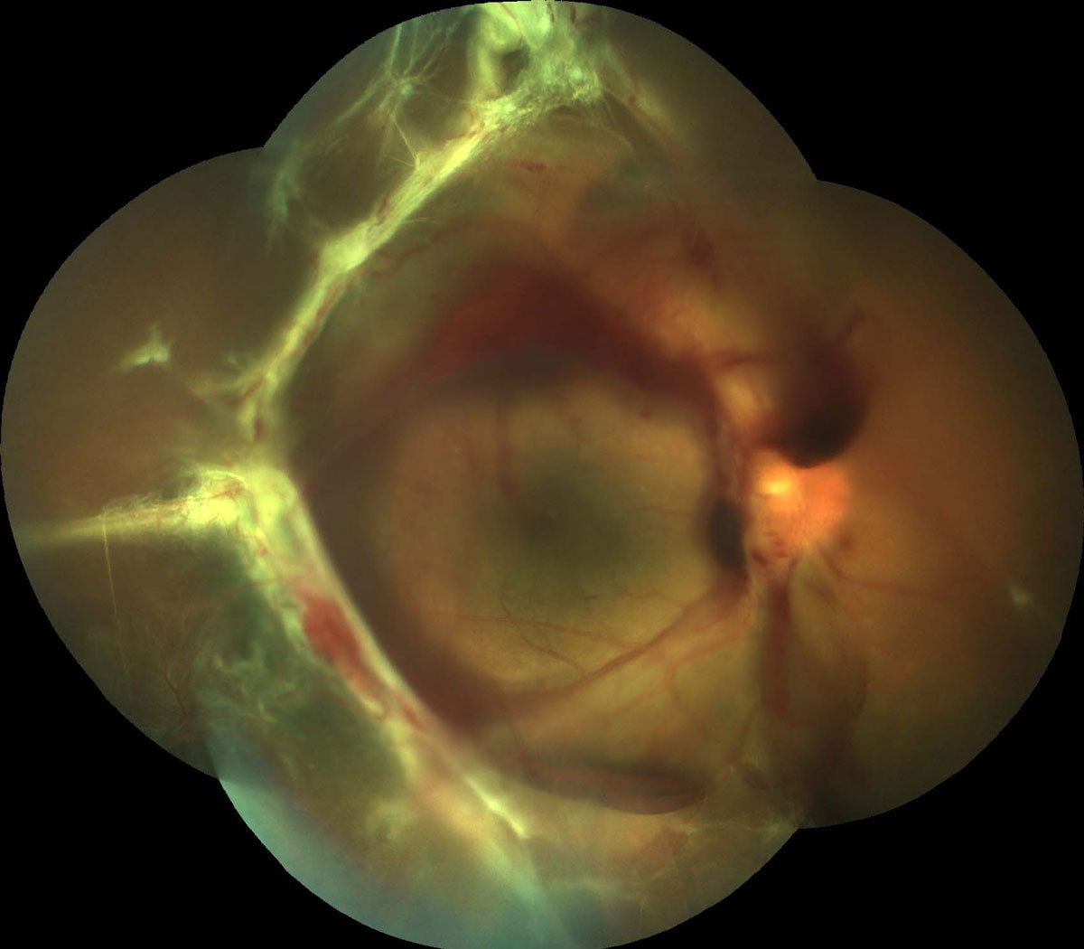 Figure 15.1.2 Tractional Retinal Detachment Threatening the Macular with Subhyaloid Hemorrhage