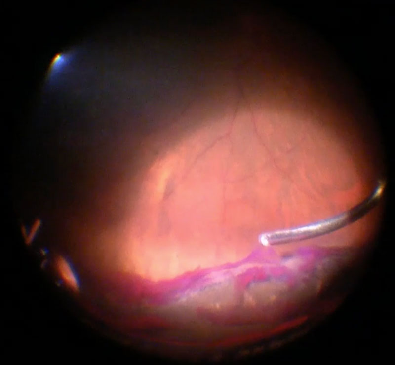 Figure 15.2.5 Scleral Indentation for Peripheral Vitrectomy