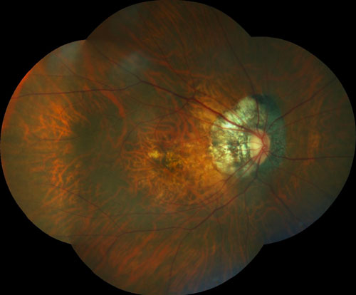 Figure 16.3.4 Scleral Depressed Search After the ILM Peel Completion