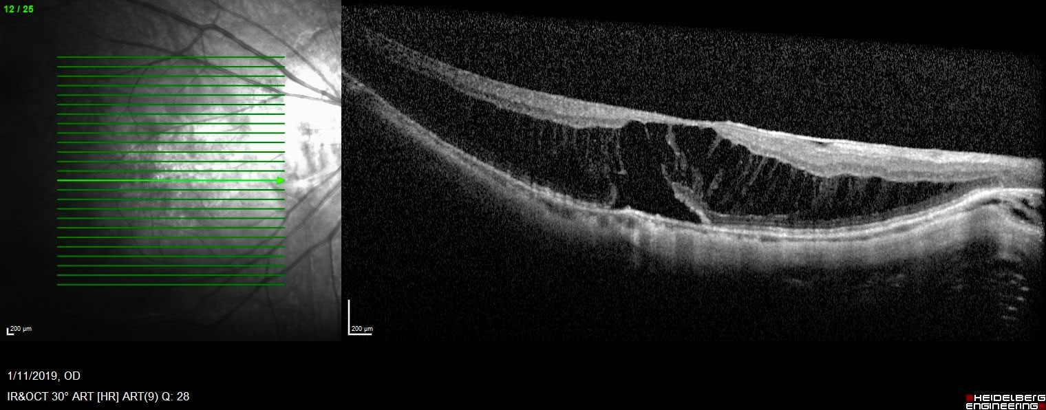Figure 16.4.2 The Spectral-domain Optical Coherence Tomography Displaying MTM with Macular “Schisis” and Foveal Detachment