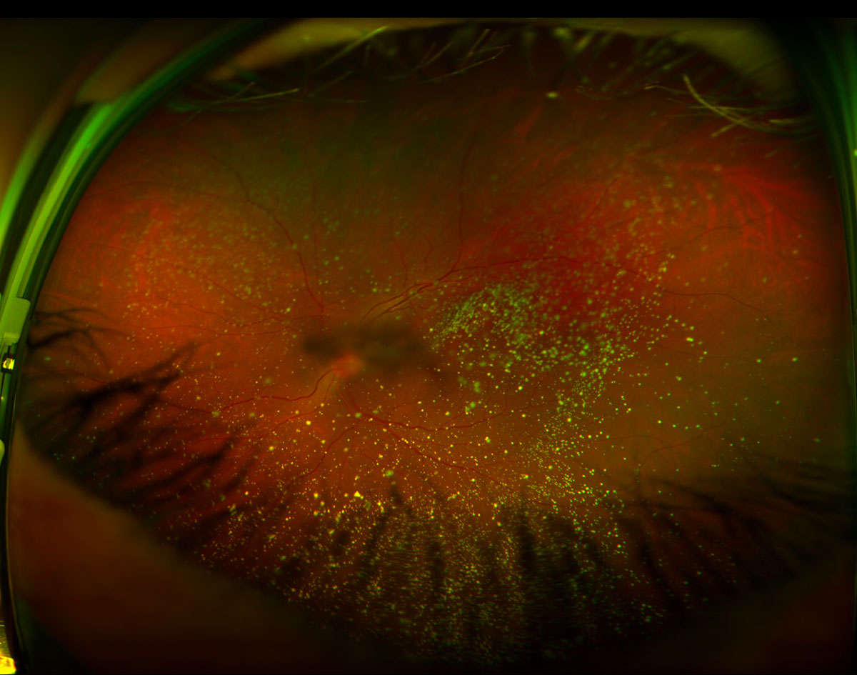 Figure 18.1.1 Although Asteroid Hyalosis is Usually Asymptomatic, it can be Symptomatic After Development of a Posterior Vitreous Detachment