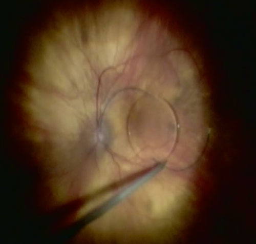 Figure 26.8.5.1 Suturing a Dislocated Intraocular Lens A