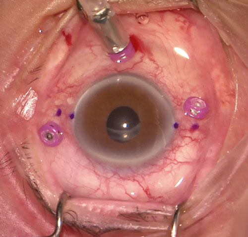 Figure 26.9.3
27-gauge Cannulae Can be Used for the Scleral Tunnels if They are Placed 180 Degrees Apart and Tunneled in Opposite Directions