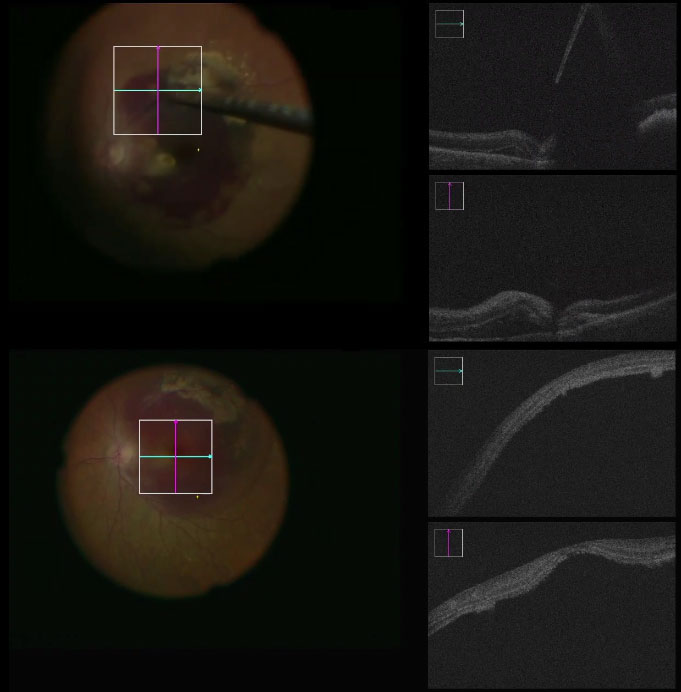 Figure 2.4.1
Digital screen with intraoperative optical coherence tomography overlay (example on the NGENUITY® platform)