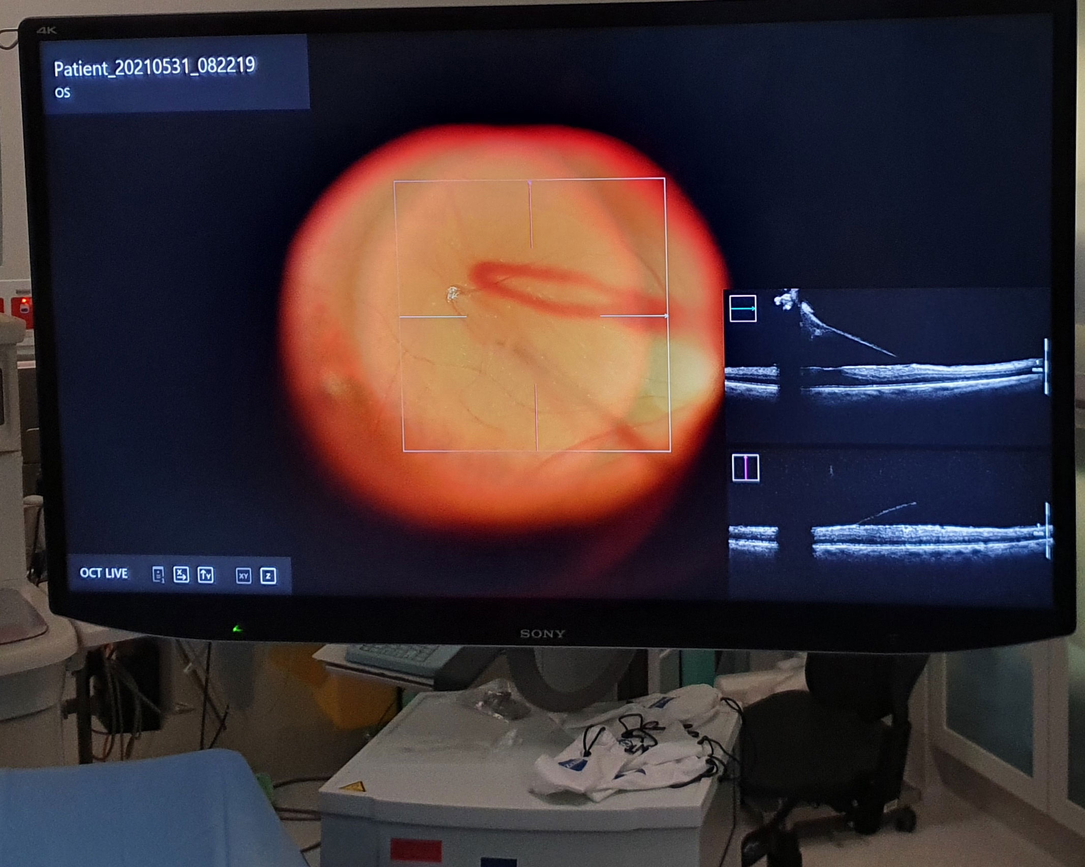 Figure 2.4.1
Digital screen with intraoperative optical coherence tomography overlay (example on the NGENUITY® platform)