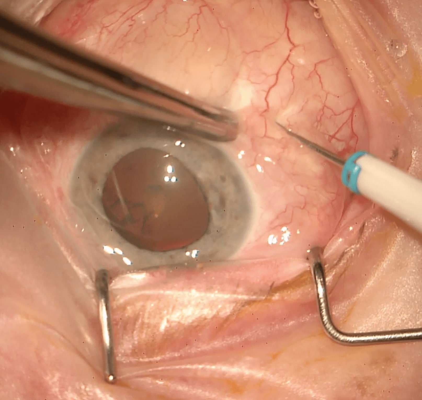 Figure 3.1.2 Insertion of a 25-gauge Valved Cannula with a Trocar System
A: Note the conjunctival displacement