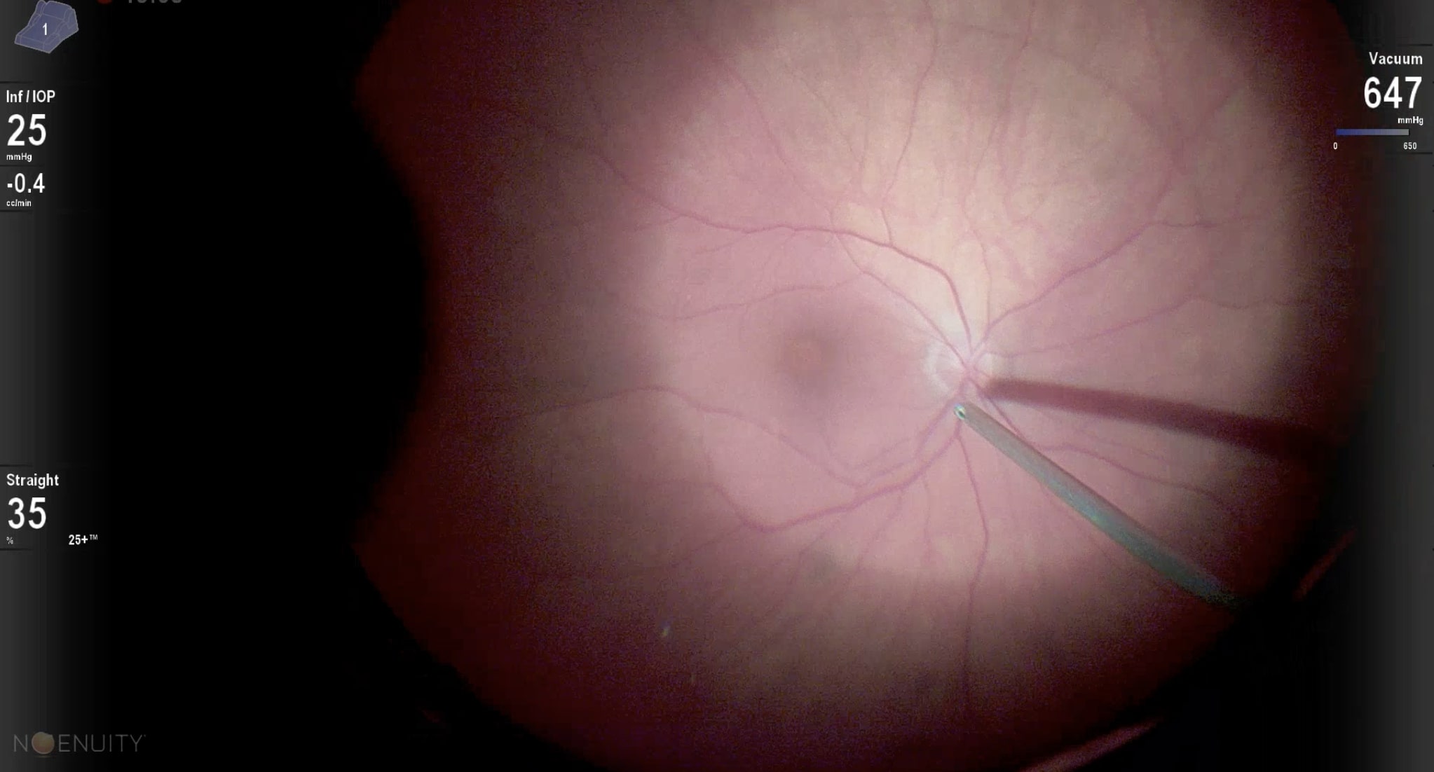 Figure 4.1 PVD Induction with the Cutter at the Optic Disc