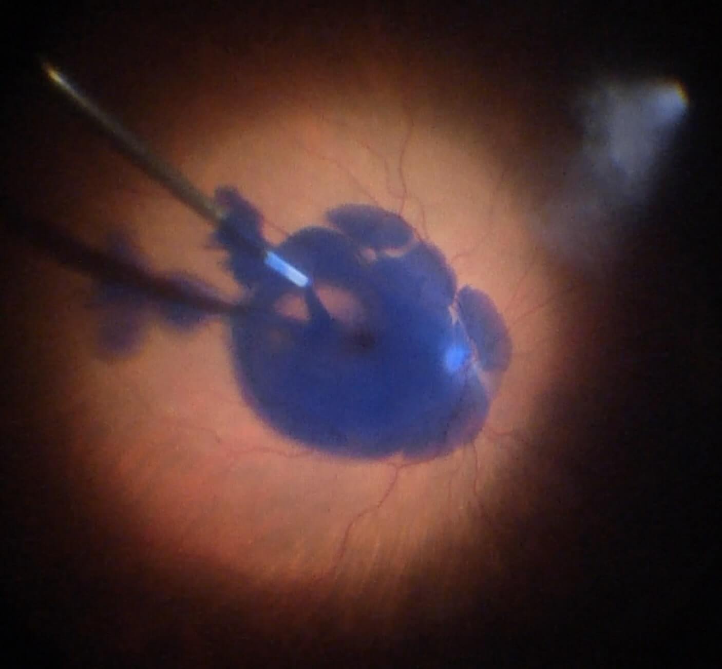 Figure 6.2 Brilliant Blue G (BBG) Used To Stain The ILM For Macular Hole Repair 