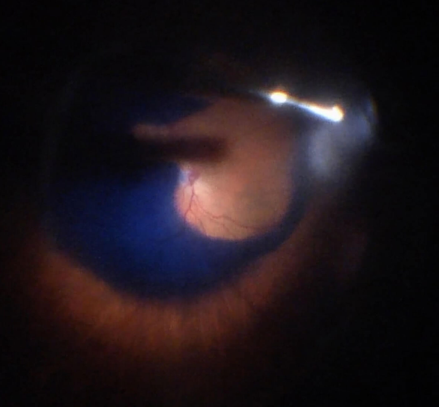 Figure 6.2 Brilliant Blue G (BBG) Used To Stain The ILM For Macular Hole Repair 