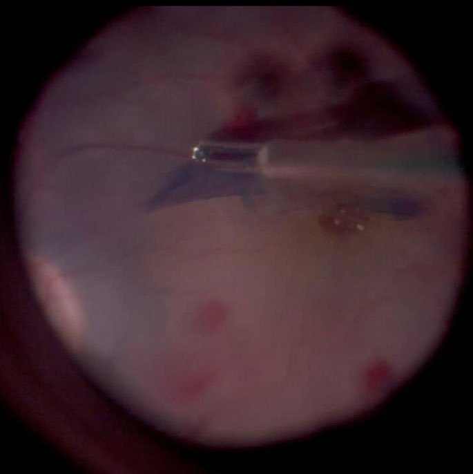 D. ILM peeling. Please note the contrast between the stained ILM grasped with the forceps (blue) and the naked retinal surface below (tan)
