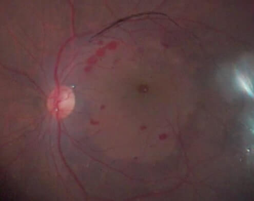 E. After ILM peeling, the retinal surface without ILM appears without blue color, in contrast with the surrounding area with blue color due to intact ILM with BBG staining.