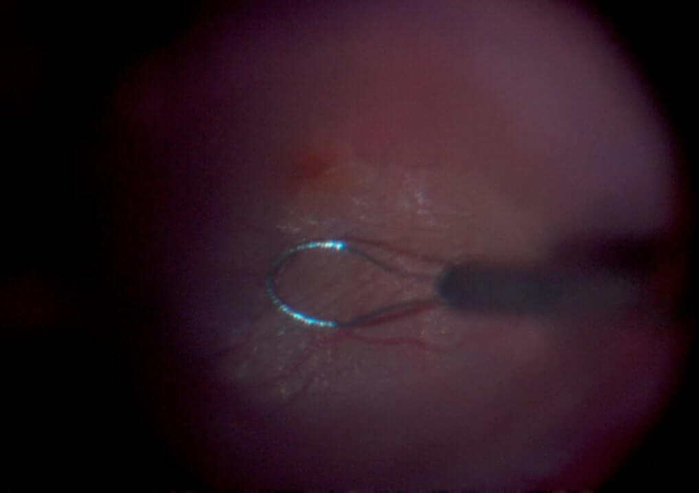 A. Negative stain area due to an epiretinal membrane (ERM)