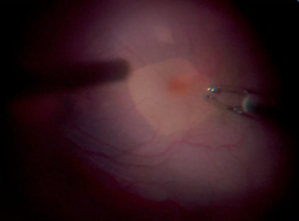 E. Area of pale-colored retina after ILM peeling.