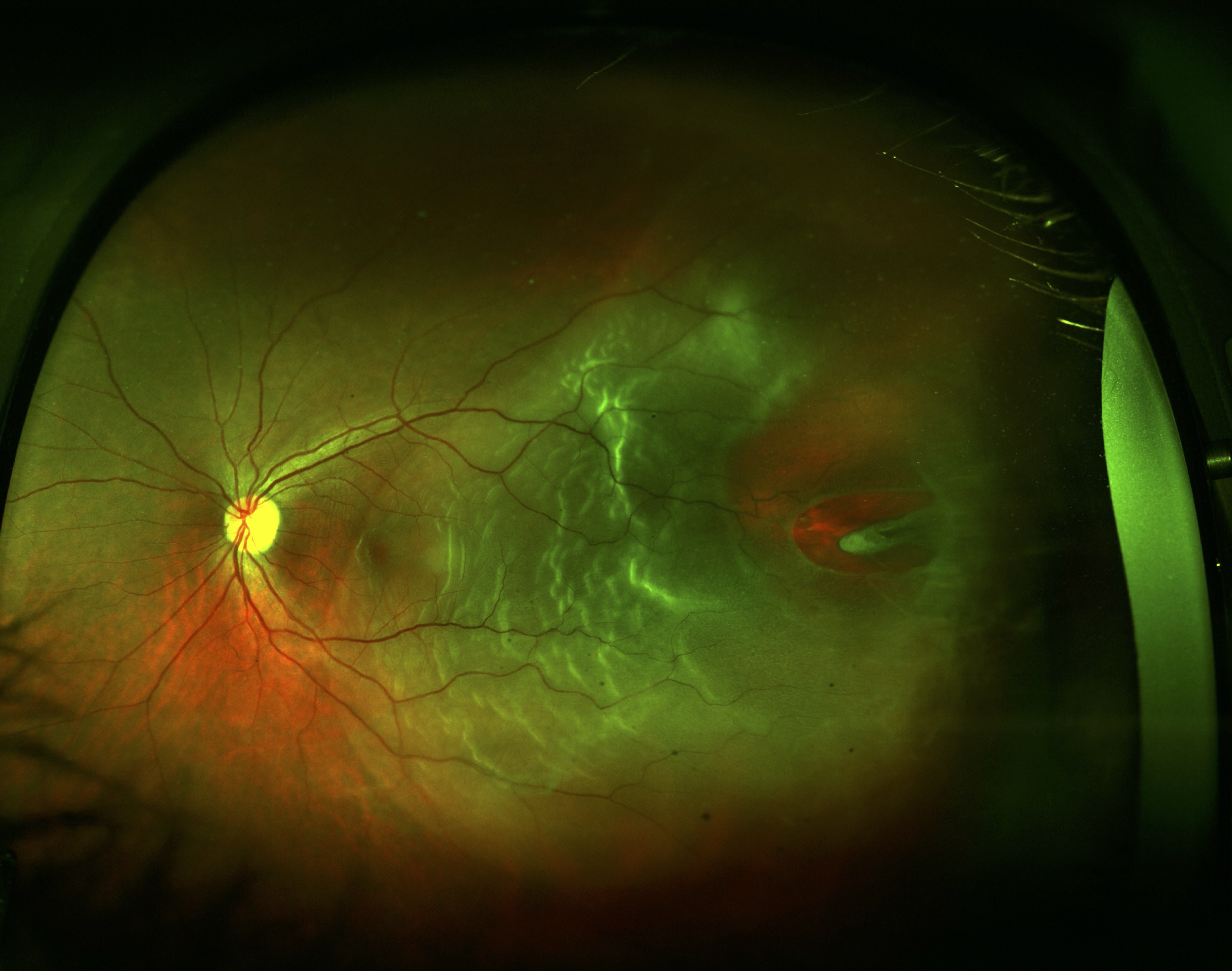 Figure 10.1.1 Total Retinal Detachment