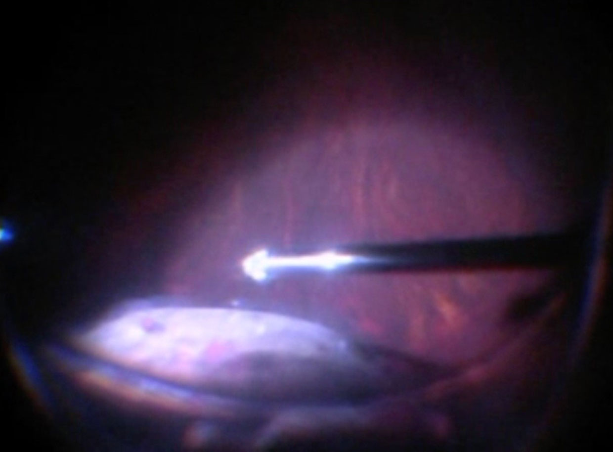 Figure 10.1.6 Scleral Indentation for Peripheral Vitrectomy A