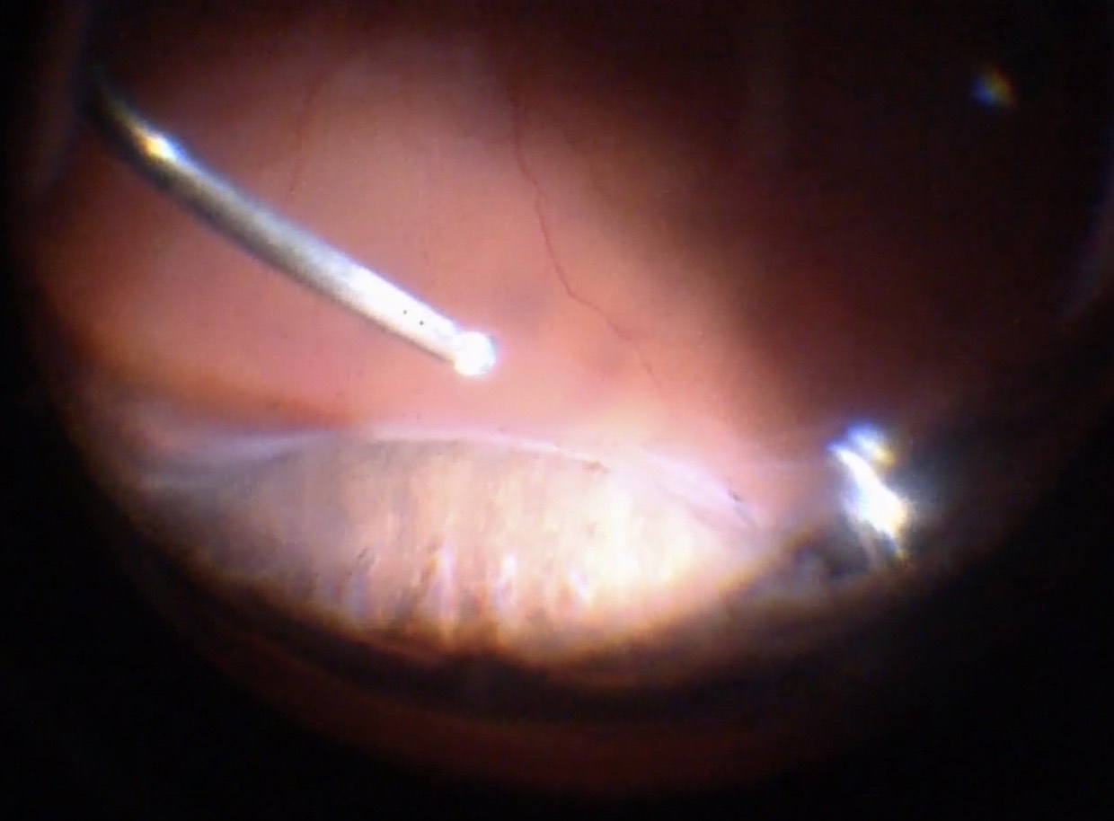 Figure 10.1.6 Scleral Indentation for Peripheral Vitrectomy B