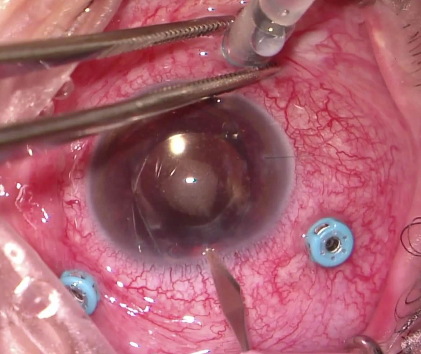 Figure 10.2.1 Removal of Silicone Oil From the Anterior Chamber A