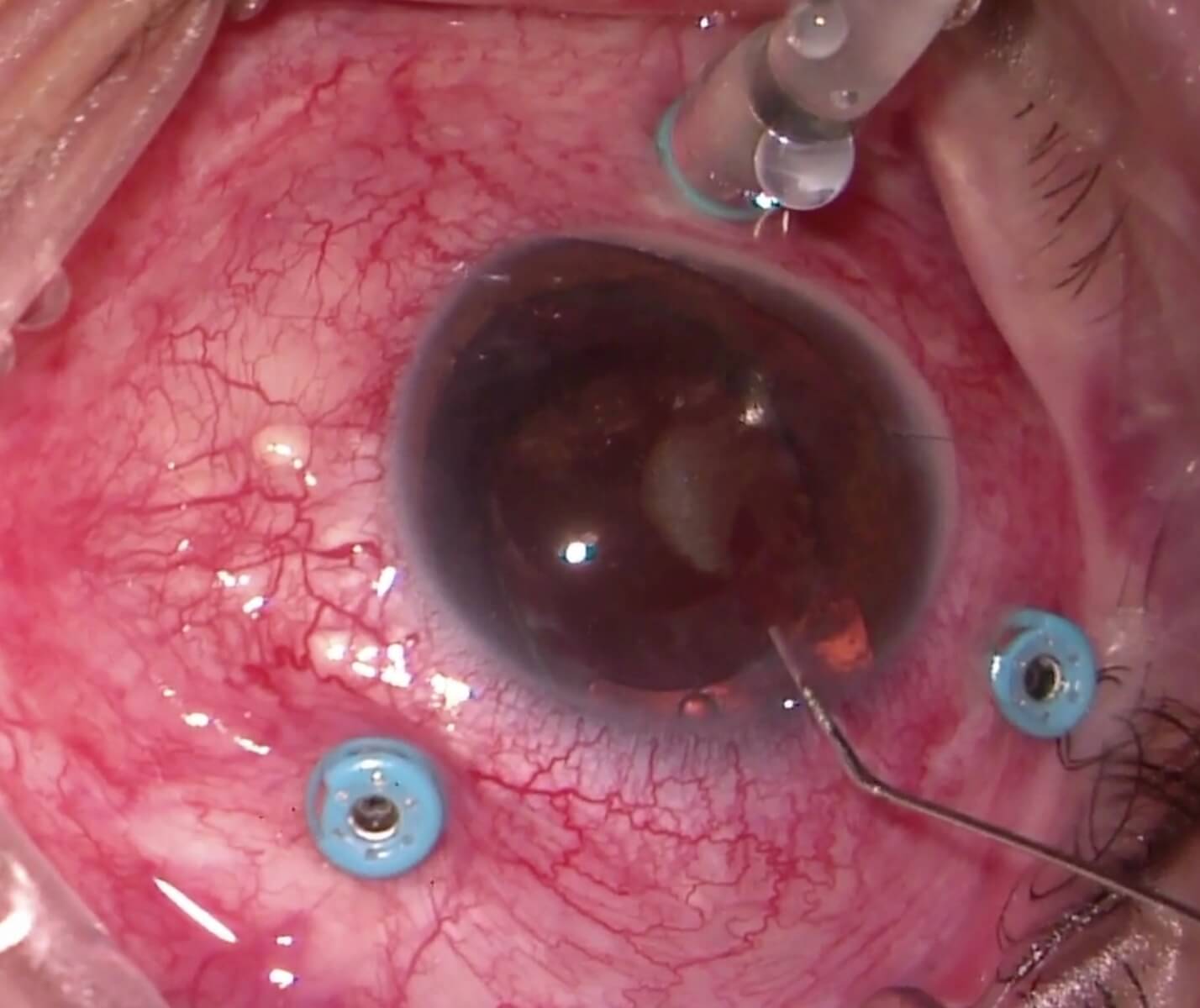 Figure 10.2.1 Removal of Silicone Oil From the Anterior Chamber B
