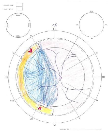 Figure 11.1.2 Phakic Retinal Detachment with Multiple Breaks B