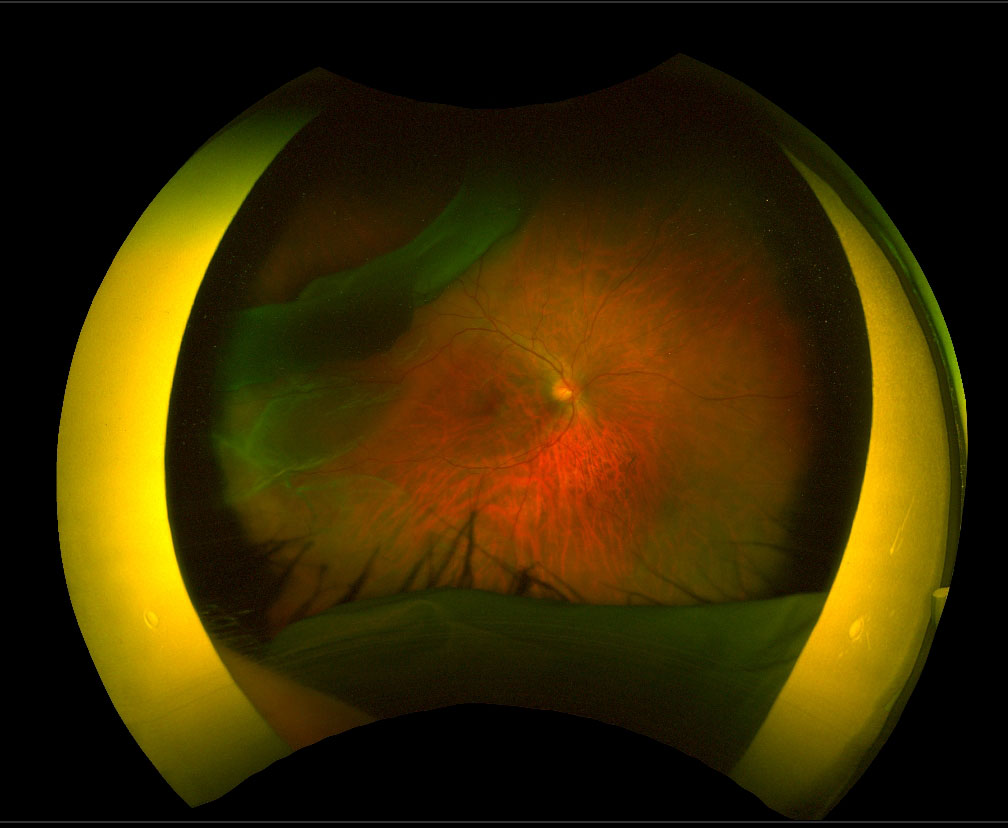 Figure 13.5.1 Giant Retinal Tear with Macular-on Detachment in a 19-year Old Male with Stickler’s Syndrome (Preoperative Vision 6/6)