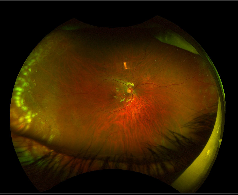Figure 13.5.1 Giant Retinal Tear with Macular-on Detachment in a 19-year Old Male with Stickler’s Syndrome (Preoperative Vision 6/6)