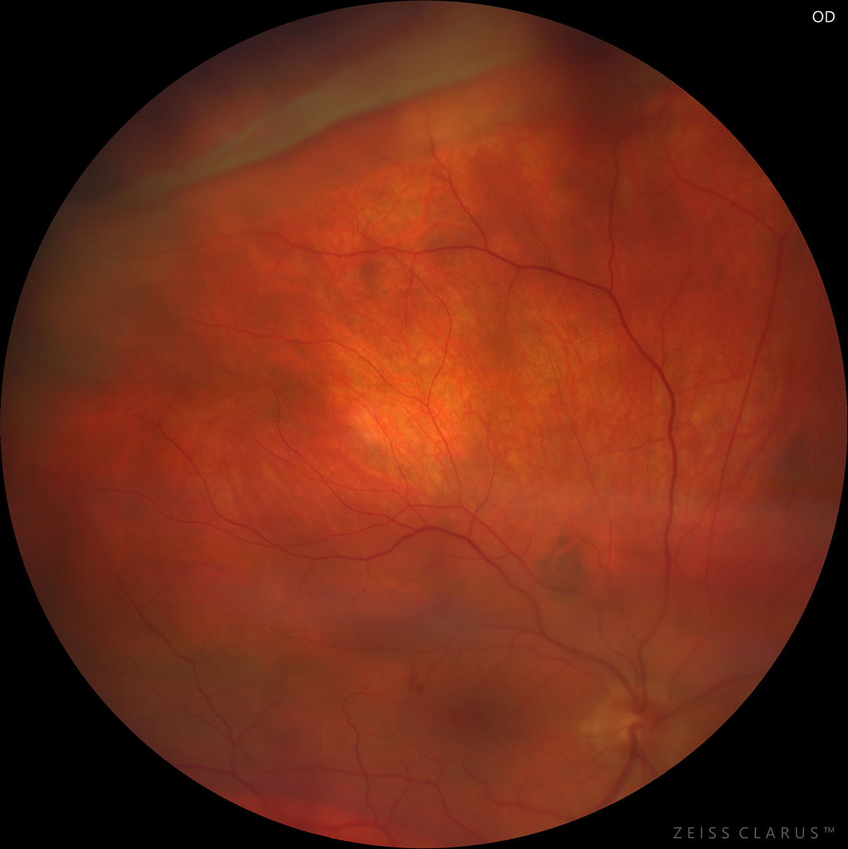 Figure 13.6.2 Retinal Dialysis at the Superotemporal Quadrant Imaged With the Zeiss Clarus®