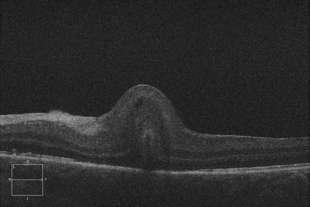 Figure 13.7.2 The Preoperative OCT Finding of a Macular Fold 