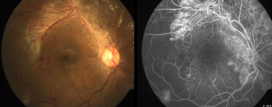 Figure 15.2.2 Proliferative Diabetic Retinopathy on Color Photograph and Fluorescein Angiography
