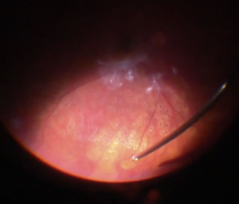 Figure 15.2.4 Vitrectomy to Separate the Anterior and Posterior Vitreous at the Mid-equatorial Region