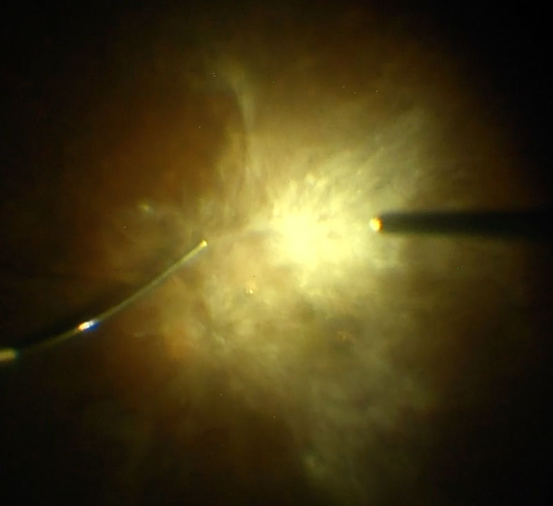 Figure 15.3.1 The Hubbard Viscodissector for Viscodissection of Preretinal Membranes
