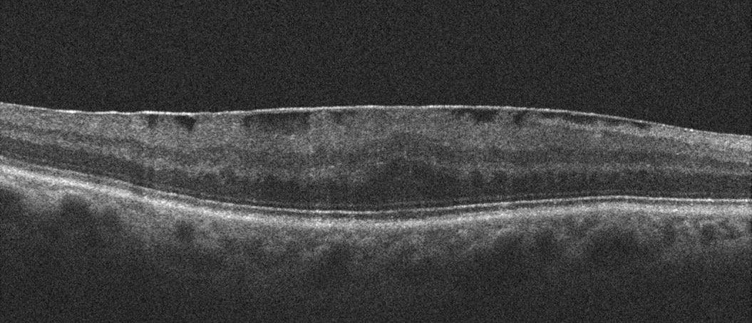 Figure 16.1.2 Epiretinal Membrane Visualized on Optical Coherence Tomography