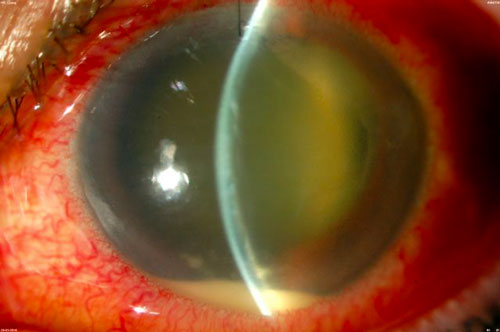 Figure 17.2 Post-operative (Cataract Extraction) Endophthalmitis