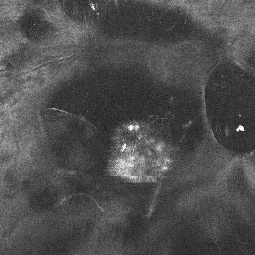 Figure 18.1.2 Pars Plana Vitrectomy is Being Performed in a Patient with Symptomatic Dense Asteroid Hyalosis