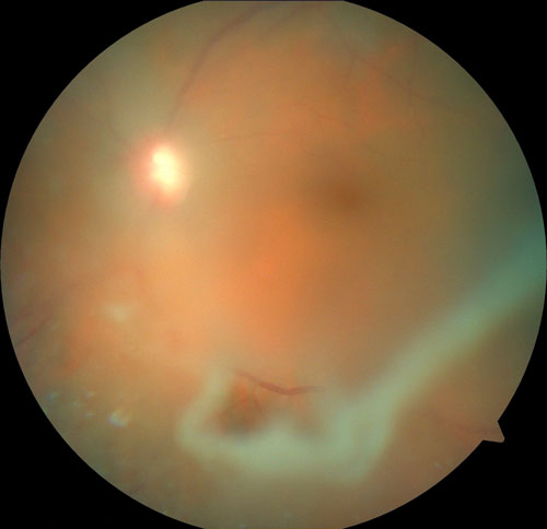 Figure 19.1.1 Vitreous Opacities Prior to Obtaining a Biopsy 