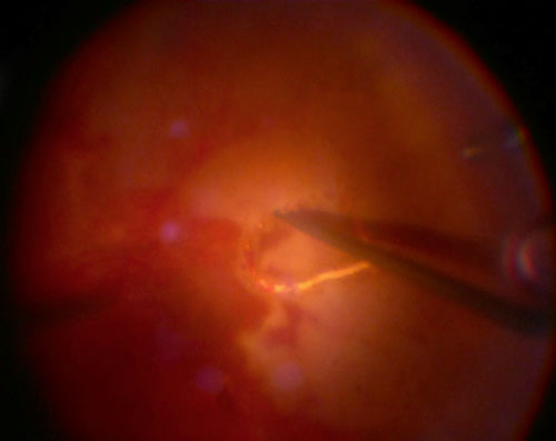 Figure 19.2.1 Retinal Biopsy in an Atypical Case of Acute Retinal Necrosis 