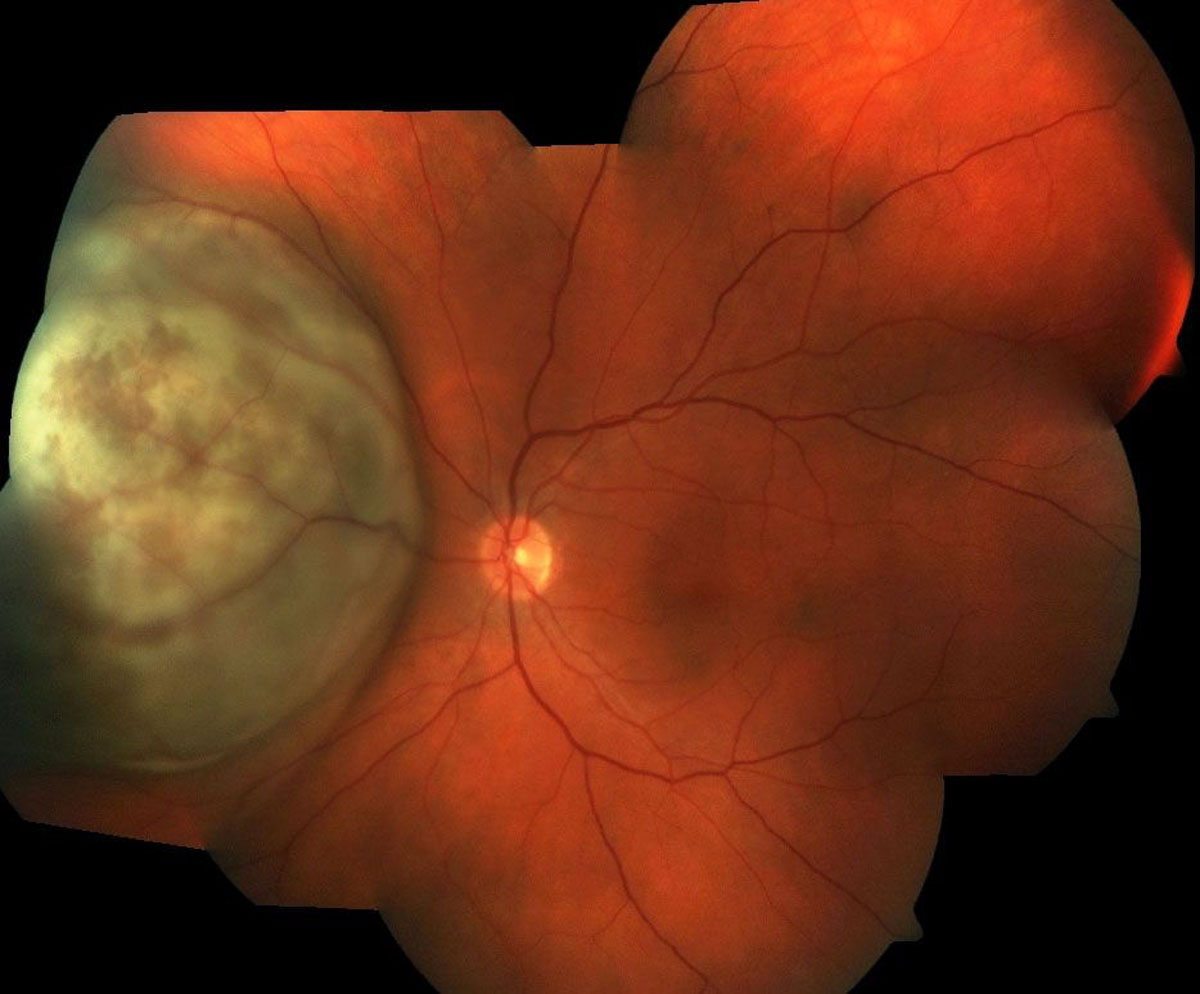 Figure 19.3.1 A Color Montage of a Large Choroidal Lesion at the Nasal Retina