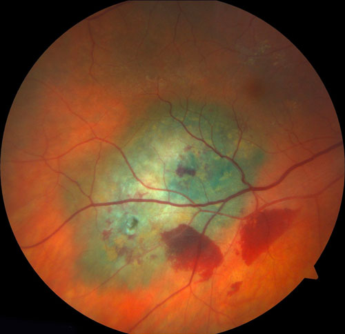 Figure 19.2.1 Retinal Biopsy in an Atypical Case of Acute Retinal Necrosis 