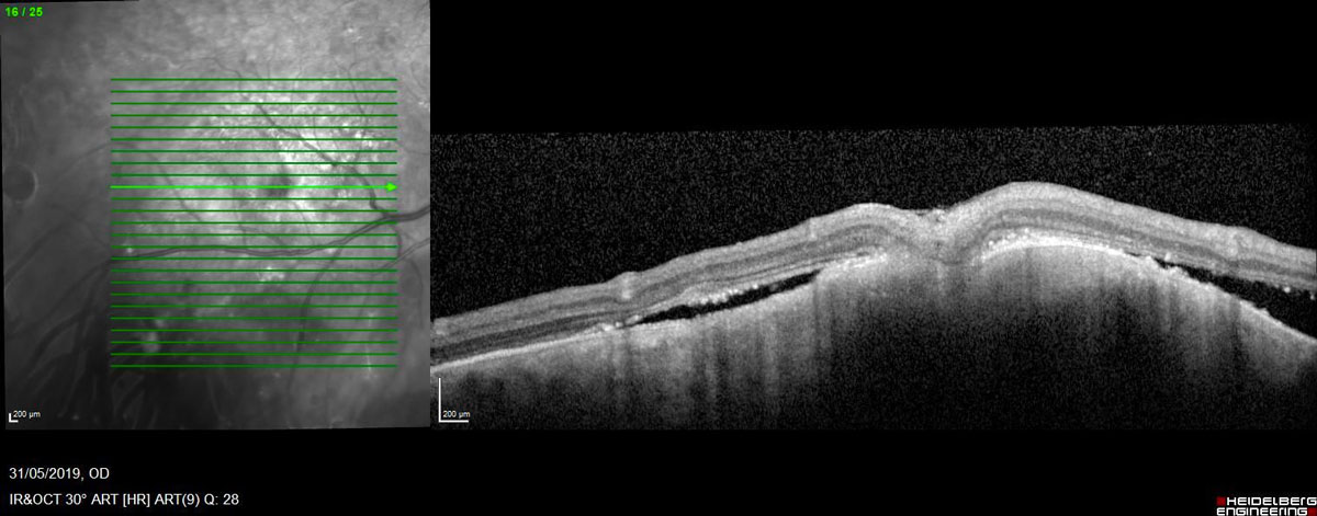 Figure 19.3.4 The Spectral-domain Optical Coherence Tomography of the Lesion (Figures 19.3.2/3) Displaying the Entry Site of the Biopsy
