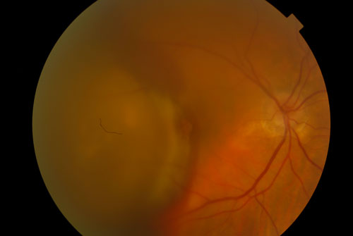 Figure 24.1 Advanced Wet Age-Related Macular Degeneration