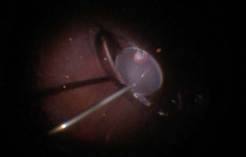 Figure 26.3.1 Removal of Dislocated Intraocular Lens
