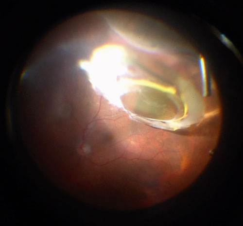 Figure 26.4.1 Dislocated Single Piece PCIOL. 
This cannot be placed in the sulcus, fixated or scleral tunneled so must be exchanged. 