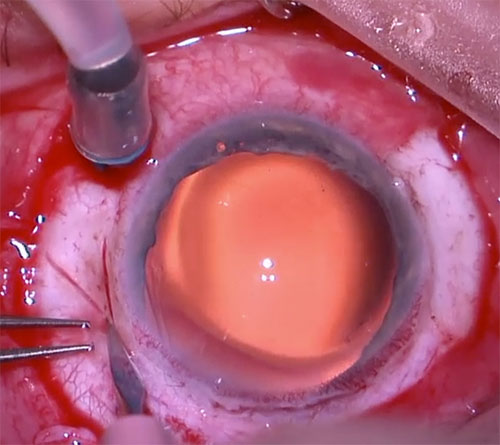 Figure 26.8.1.1 A Creating Triangular Scleral Flaps
