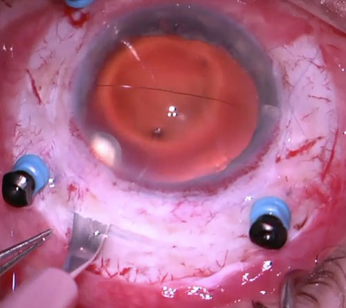 Figure 26.8.1.3 Scleral Tunnel