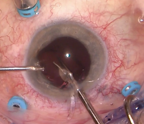 Figure 26.8.1.5 Cutting a Single Piece IOL in the Anterior Chamber IOL for Exchange