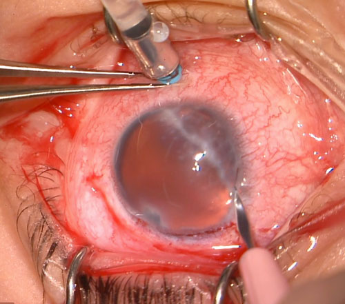Figure 26.8.3.2 A 15 Degree Blade used to Create a Scleral Pocket 