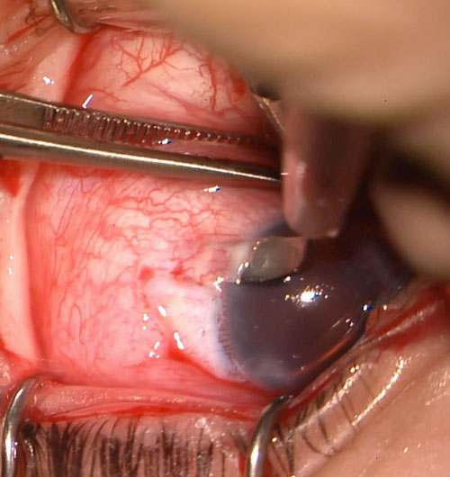 Figure 26.8.3.3 Dissection of Scleral Pockets with a Crescent Blade