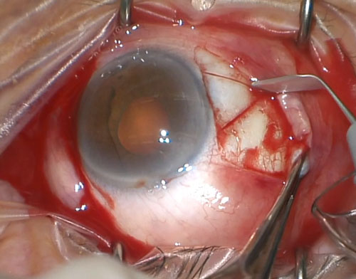 Figure 26.8.4.1 Triangular Shaped, Partial Thickness Scleral Flaps are Fashioned